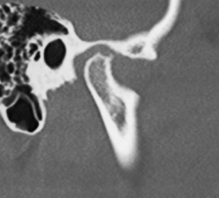 TMJ case study