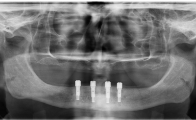 Dental Implant case study