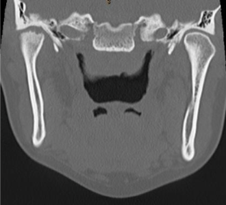 TMJ case study