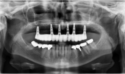 Dental Implant case study