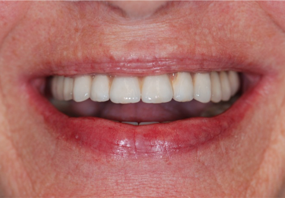 Dental Implant case study