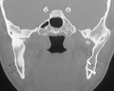 TMJ case study