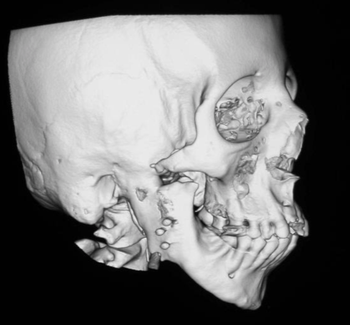 TMJ case study