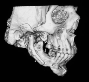 TMJ case study