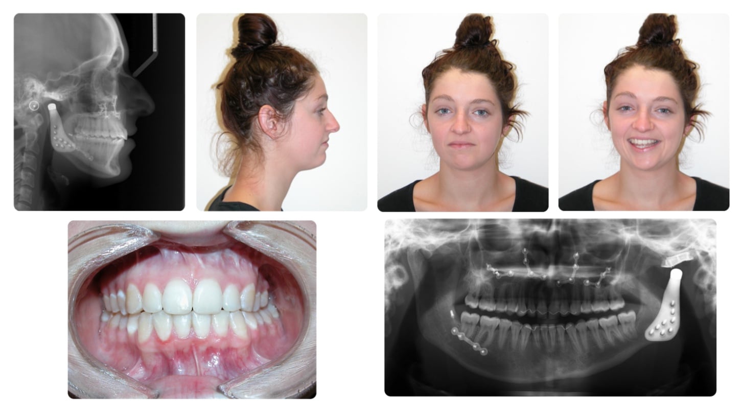 Corrective jaw surgery case study