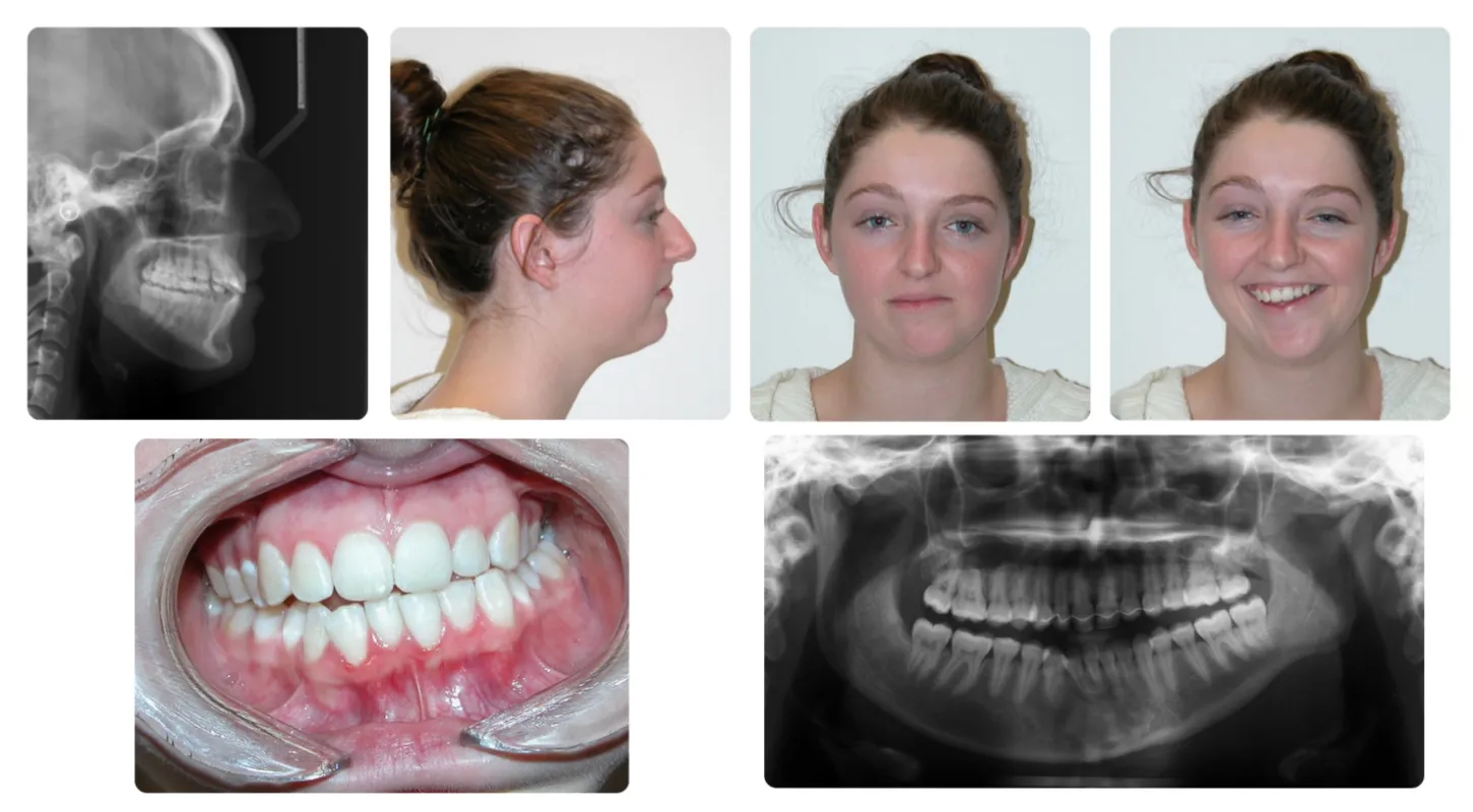 Corrective jaw surgery case study