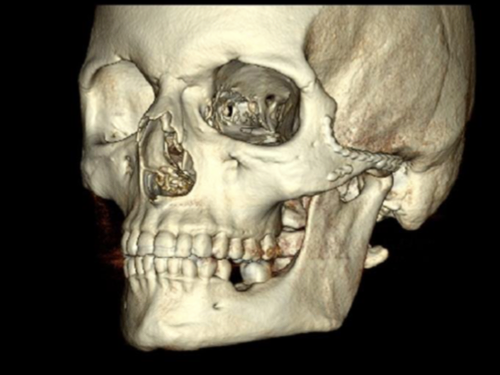 Facial trauma case study