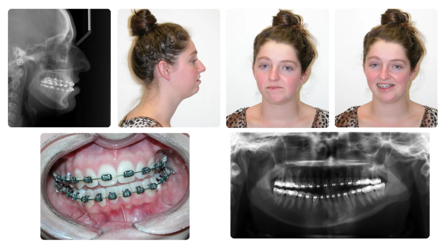 Corrective jaw surgery case study