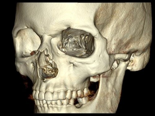 Facial trauma case study