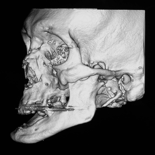 Dental Implant case study