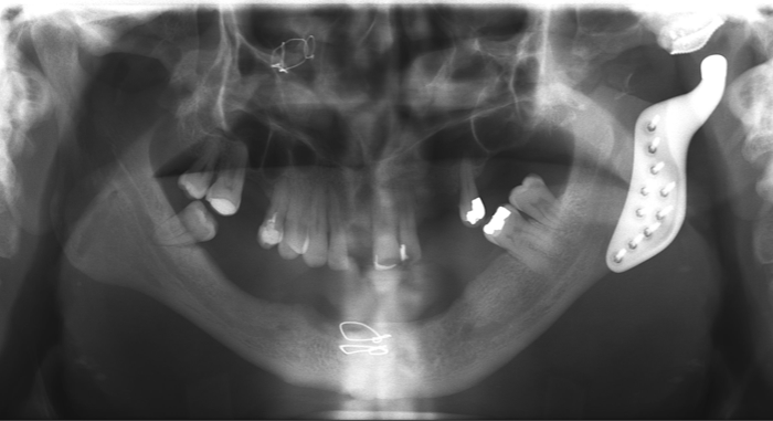 Dental Implant case study