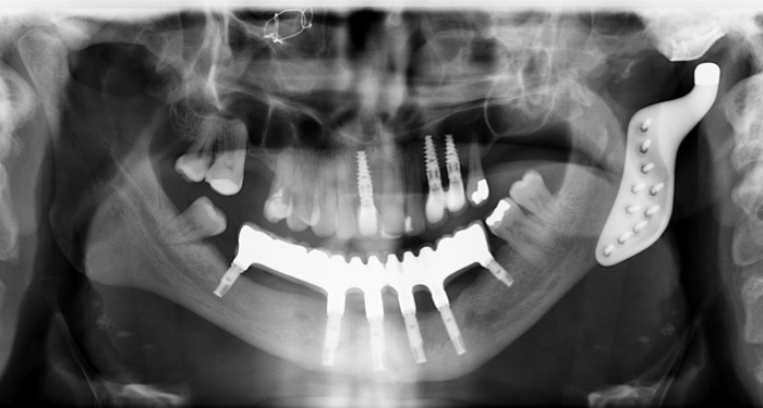 Dental Implant case study