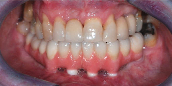 Dental Implant case study