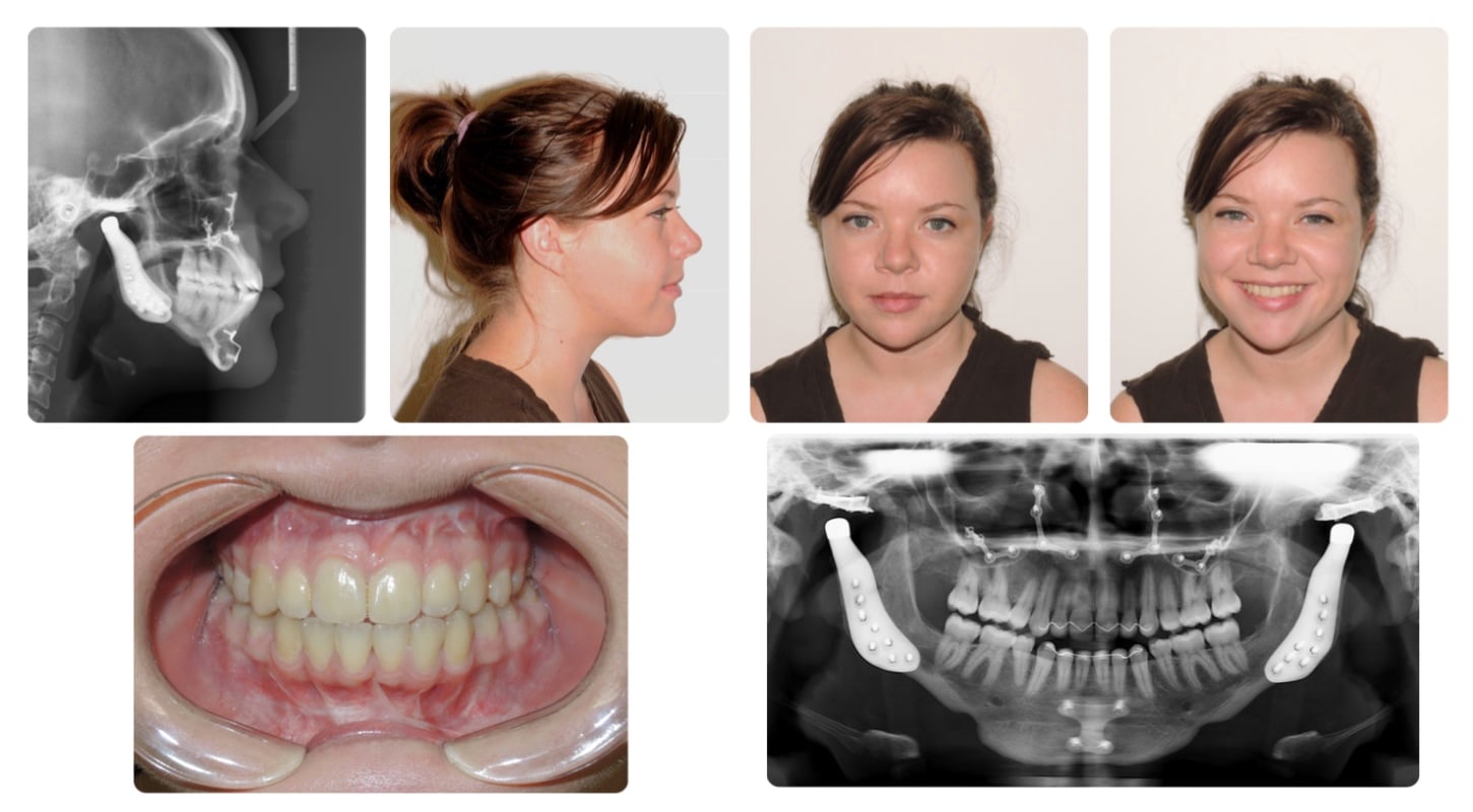 Corrective jaw surgery case study
