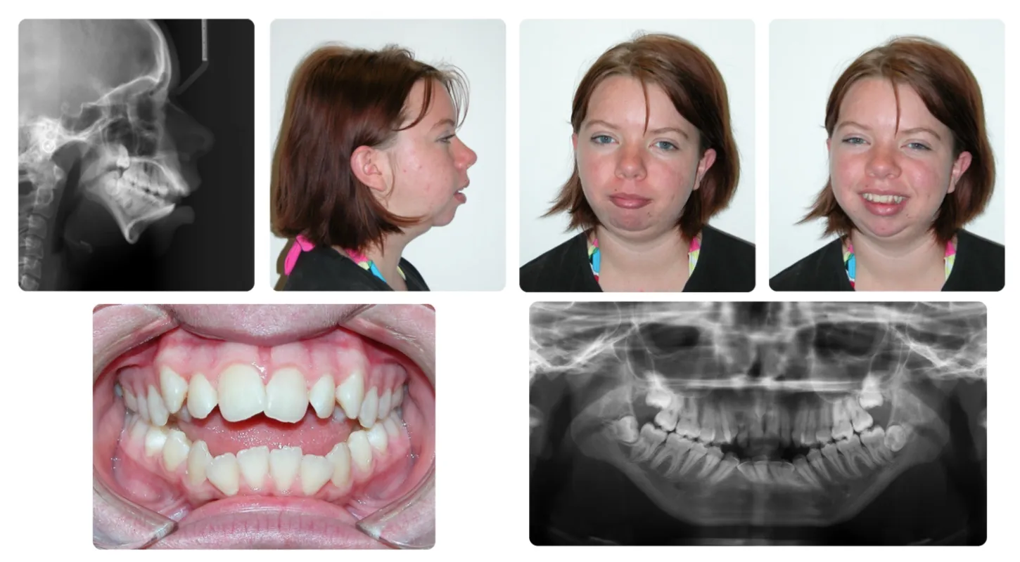 Corrective jaw surgery case study