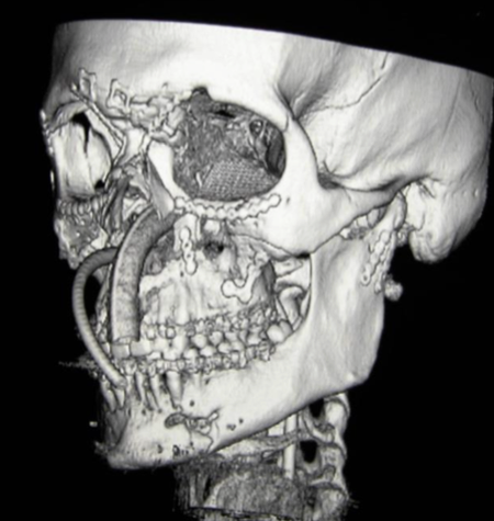 Facial trauma case study