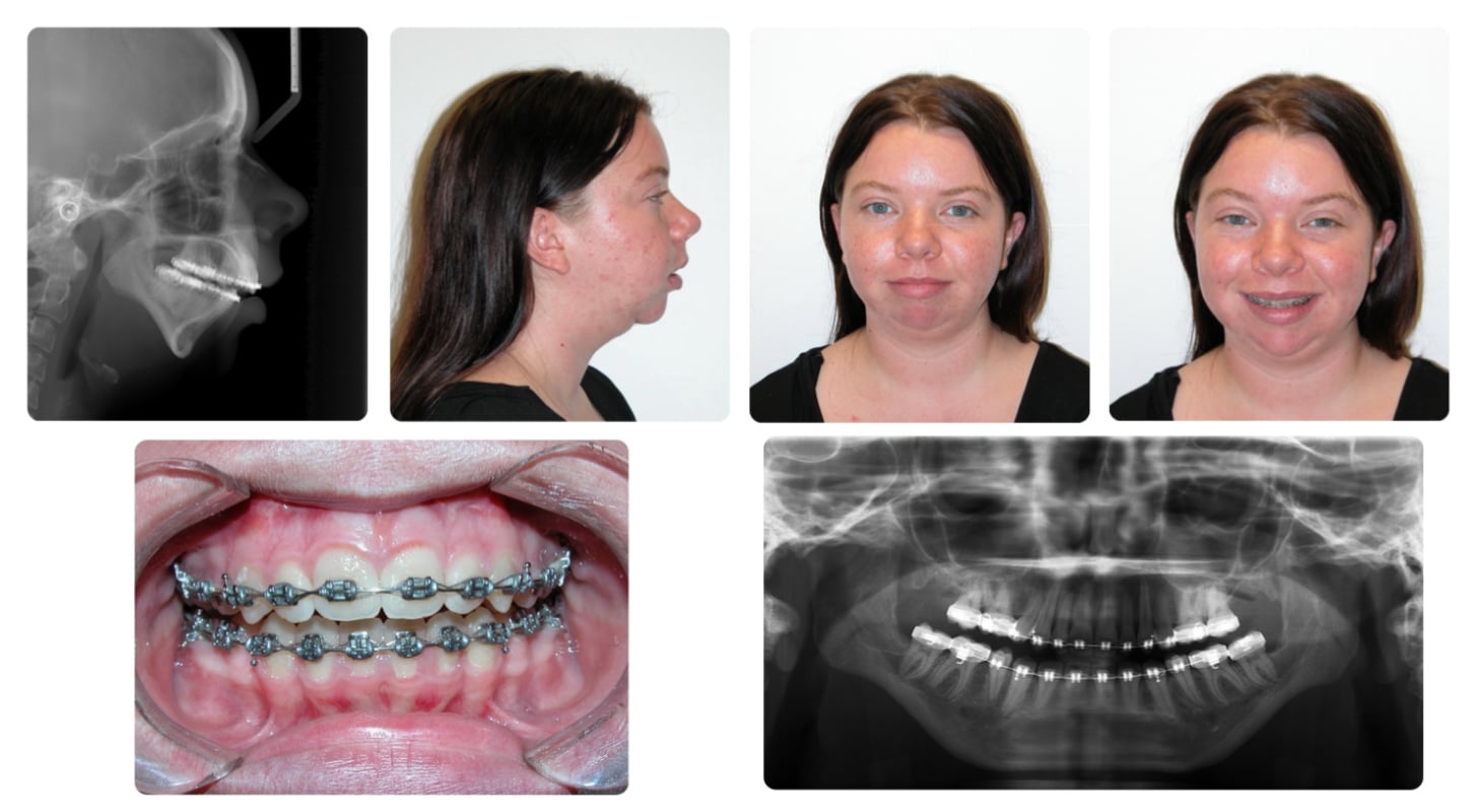 Corrective jaw surgery case study