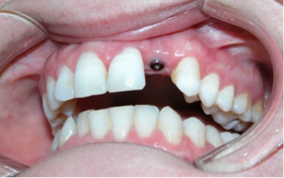 Dental Implant case study