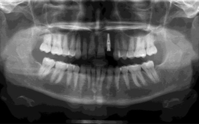 Dental Implant case study
