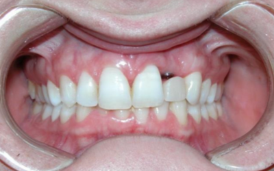 Dental Implant case study