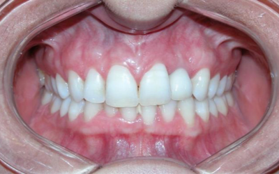 Dental Implant case study