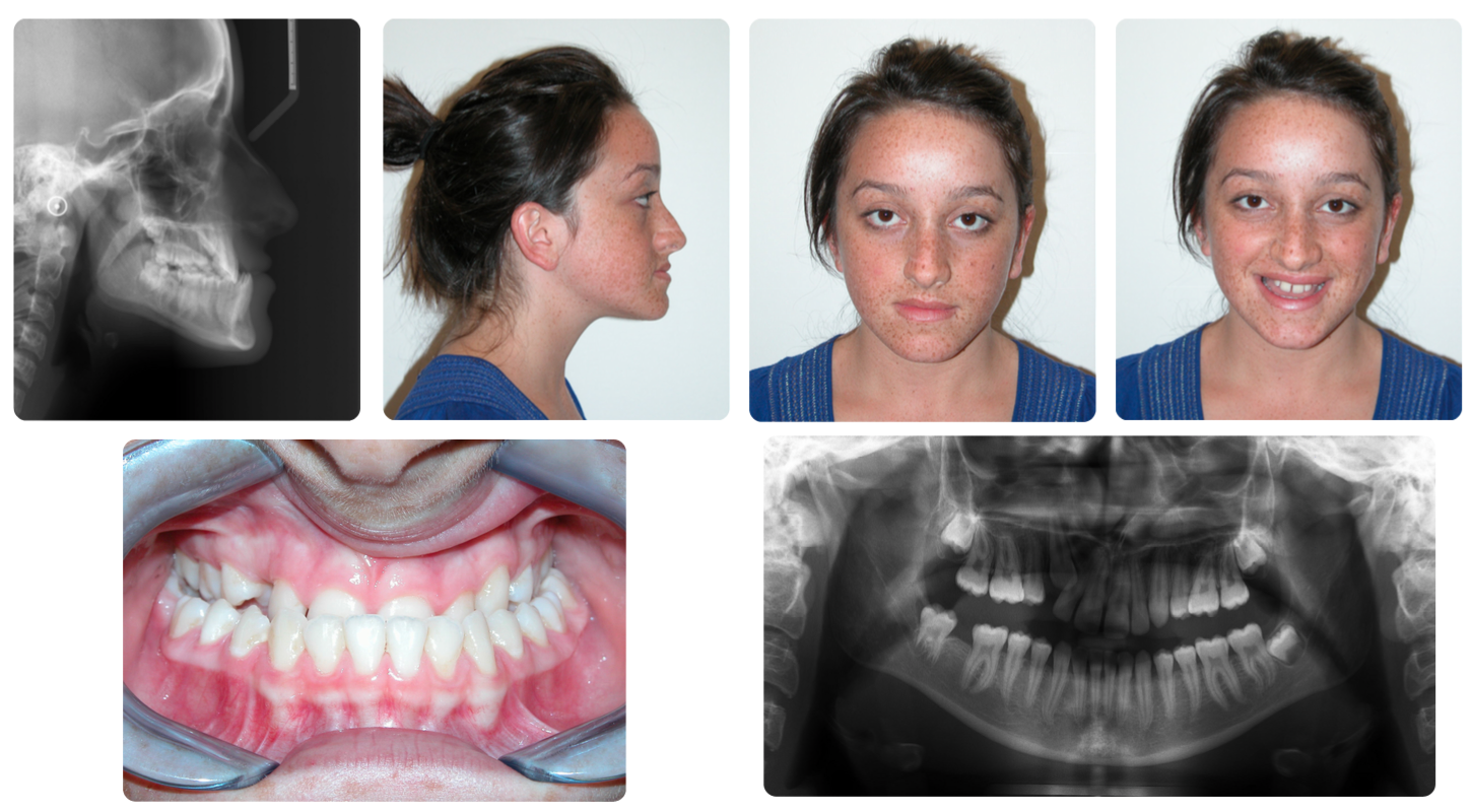 Corrective jaw surgery case study