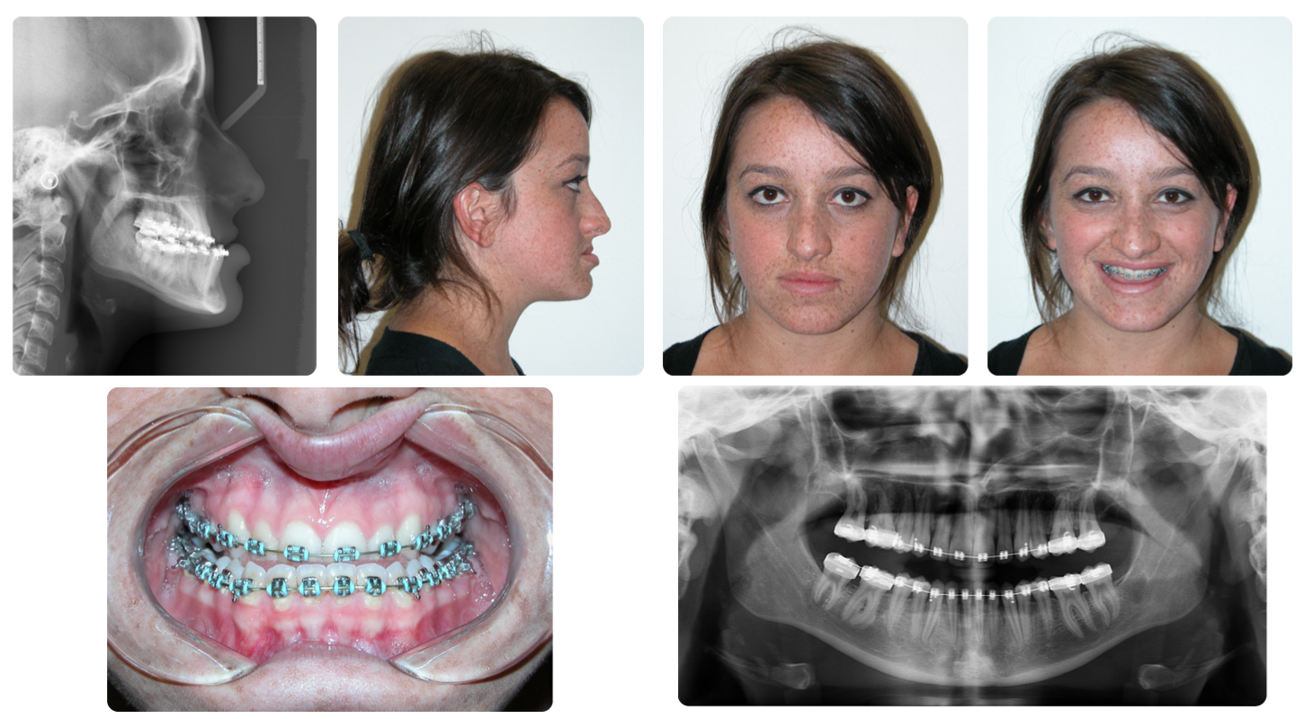Corrective jaw surgery case study