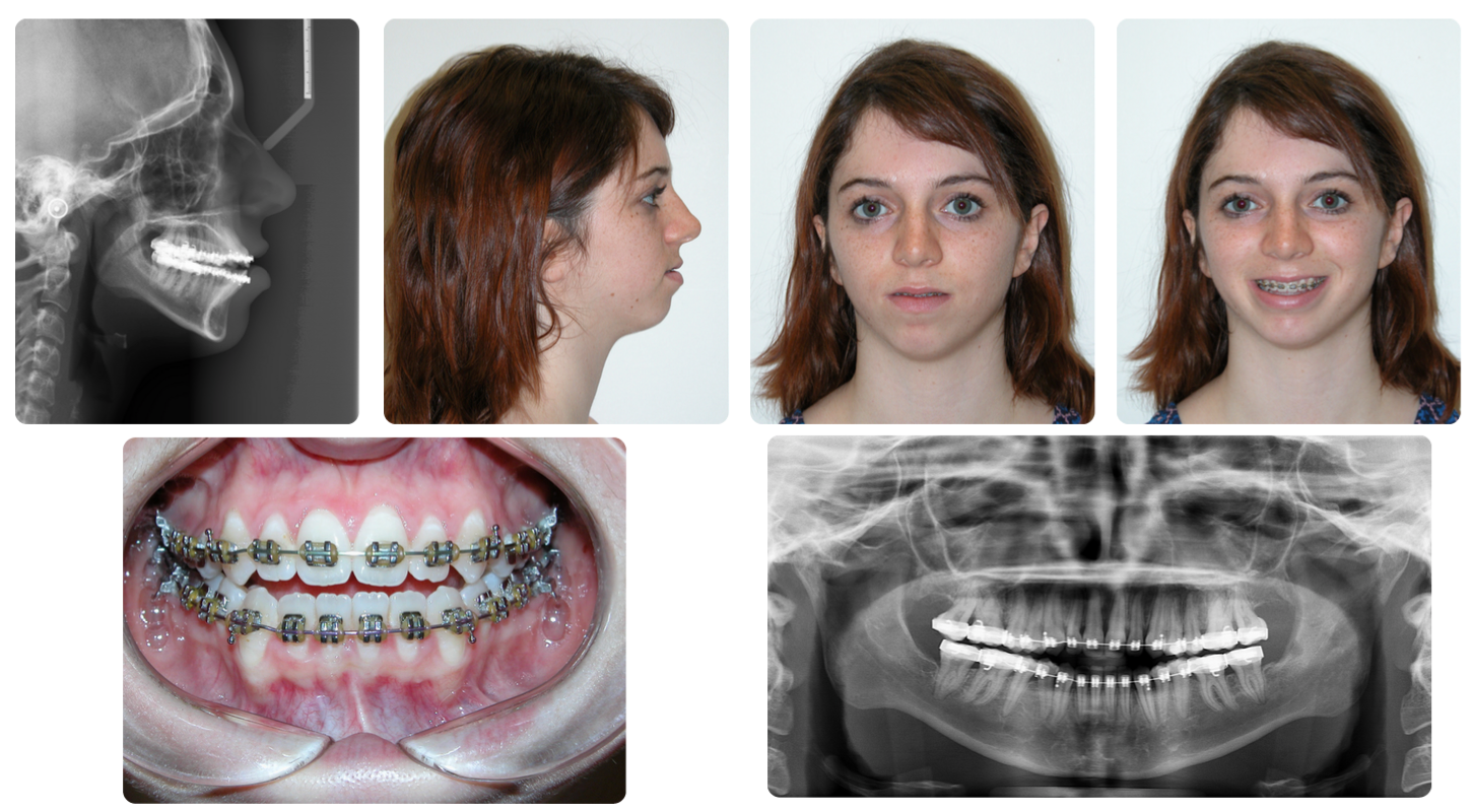 Corrective jaw surgery case study